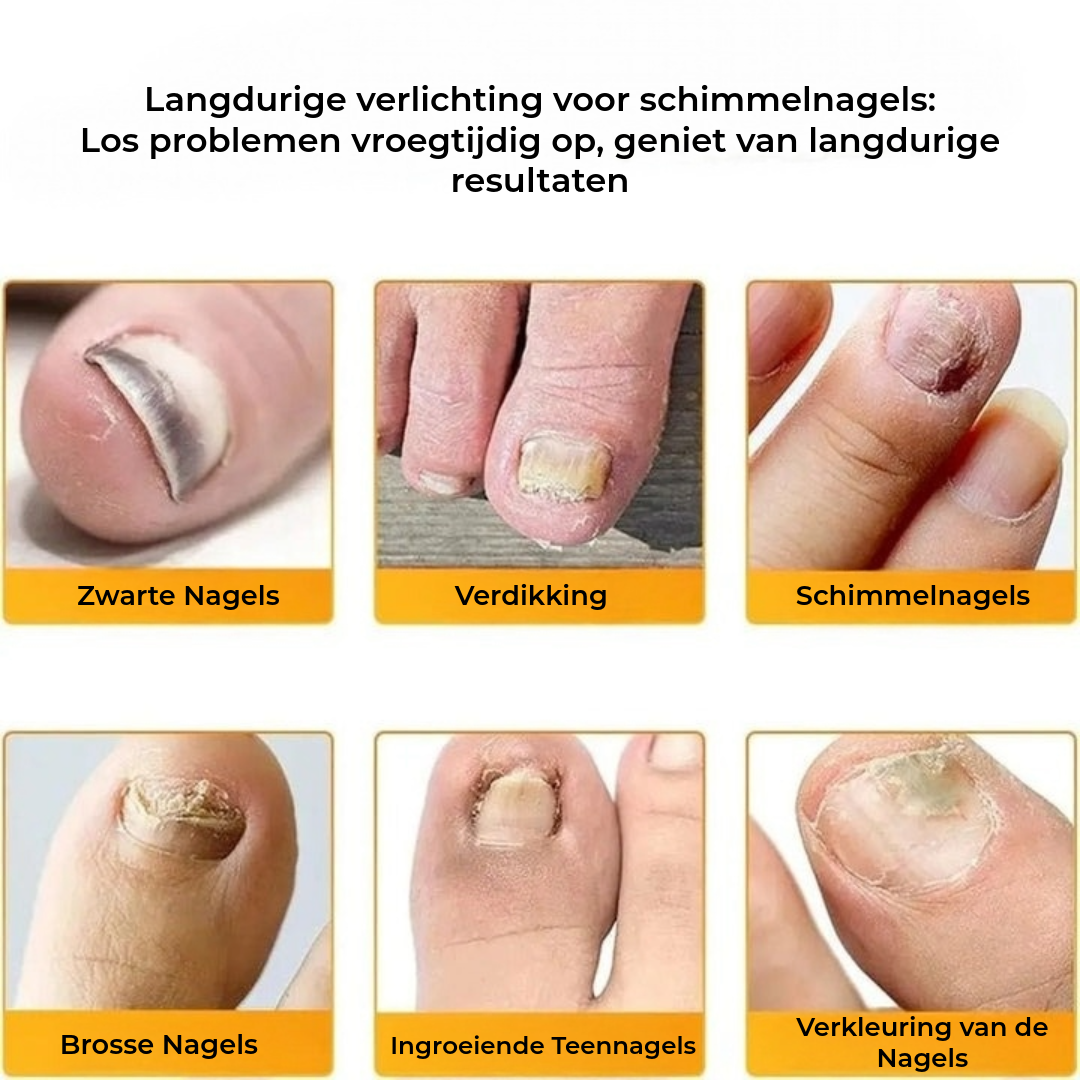 FungalPatch - Intensieve Nagelverzorging Set - Zelfklevende Schimmelwerende Pleisters