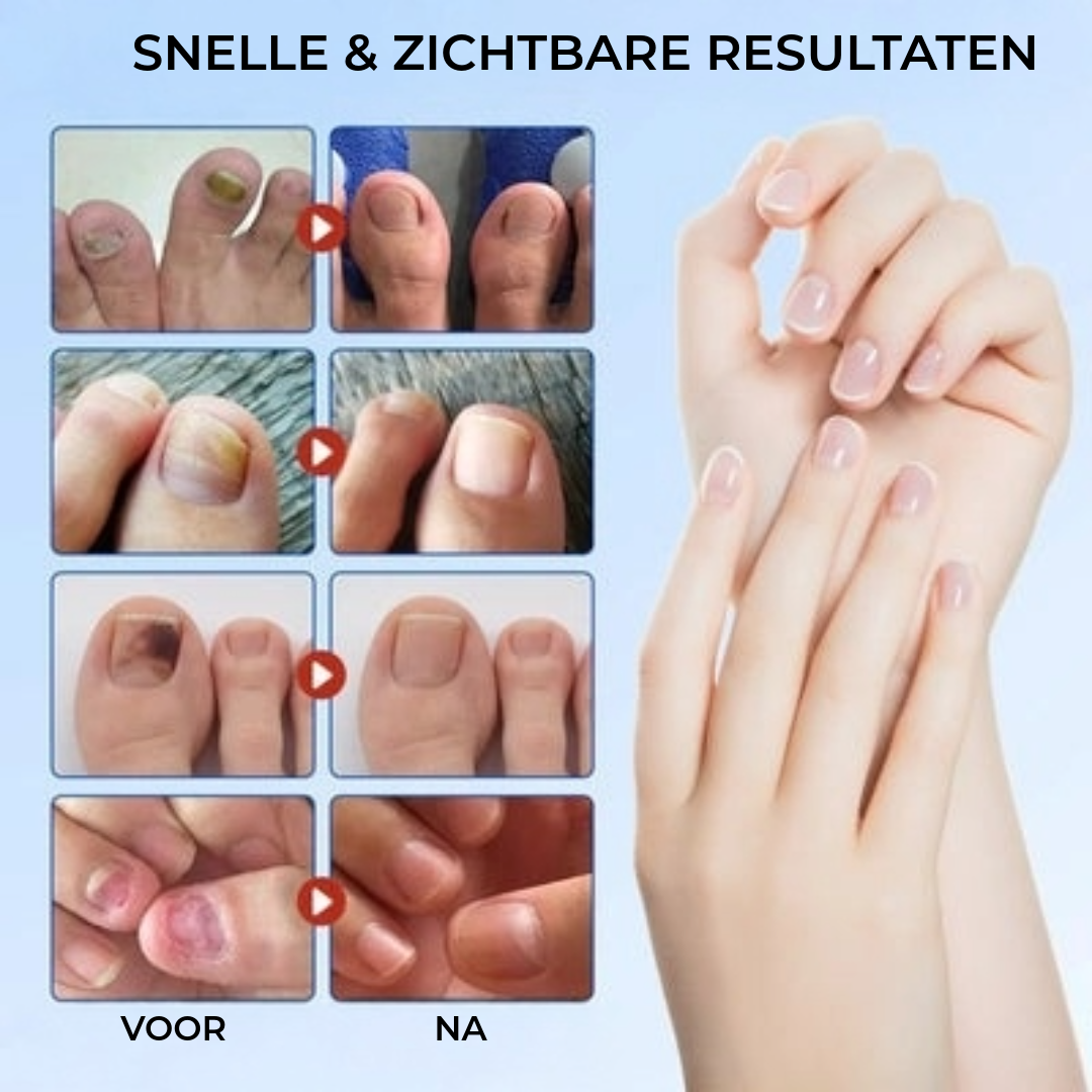 FungalPatch - Intensieve Nagelverzorging Set - Zelfklevende Schimmelwerende Pleisters