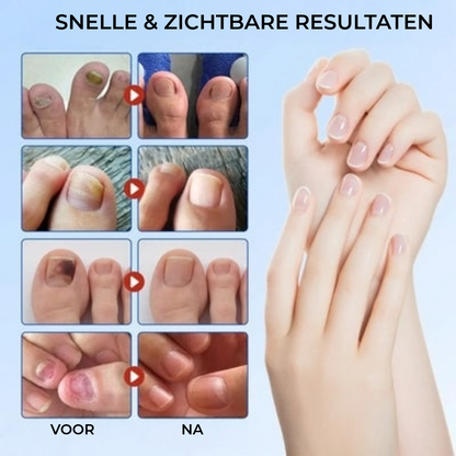 FungalPatch - Intensieve Nagelverzorging Set - Zelfklevende Schimmelwerende Pleisters